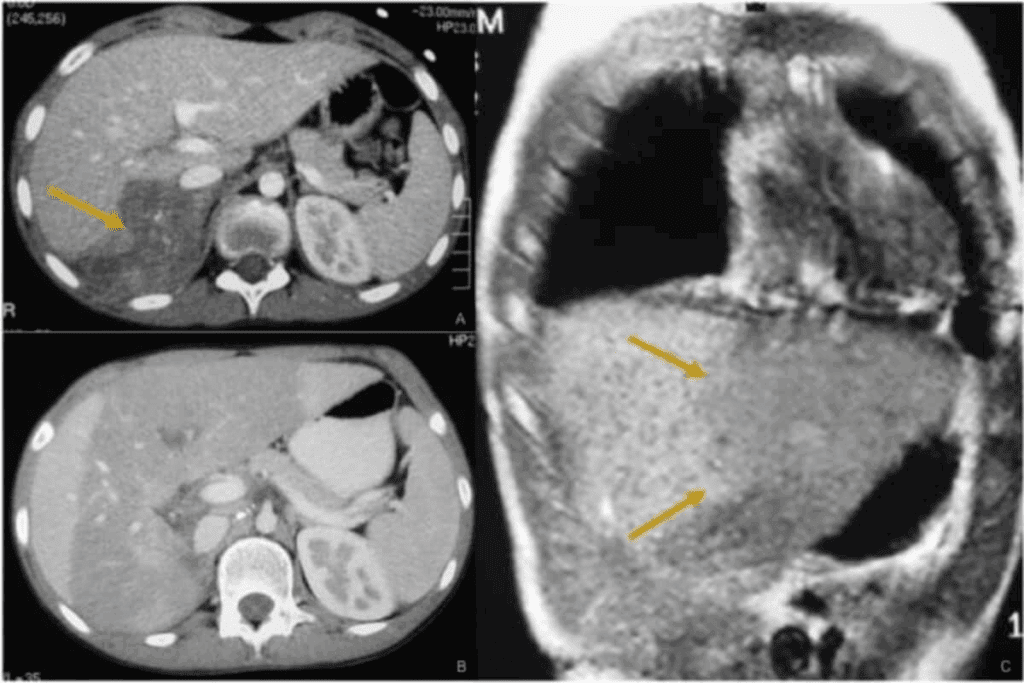 Neuroblastoma Prognosis: Understanding the Last Stage