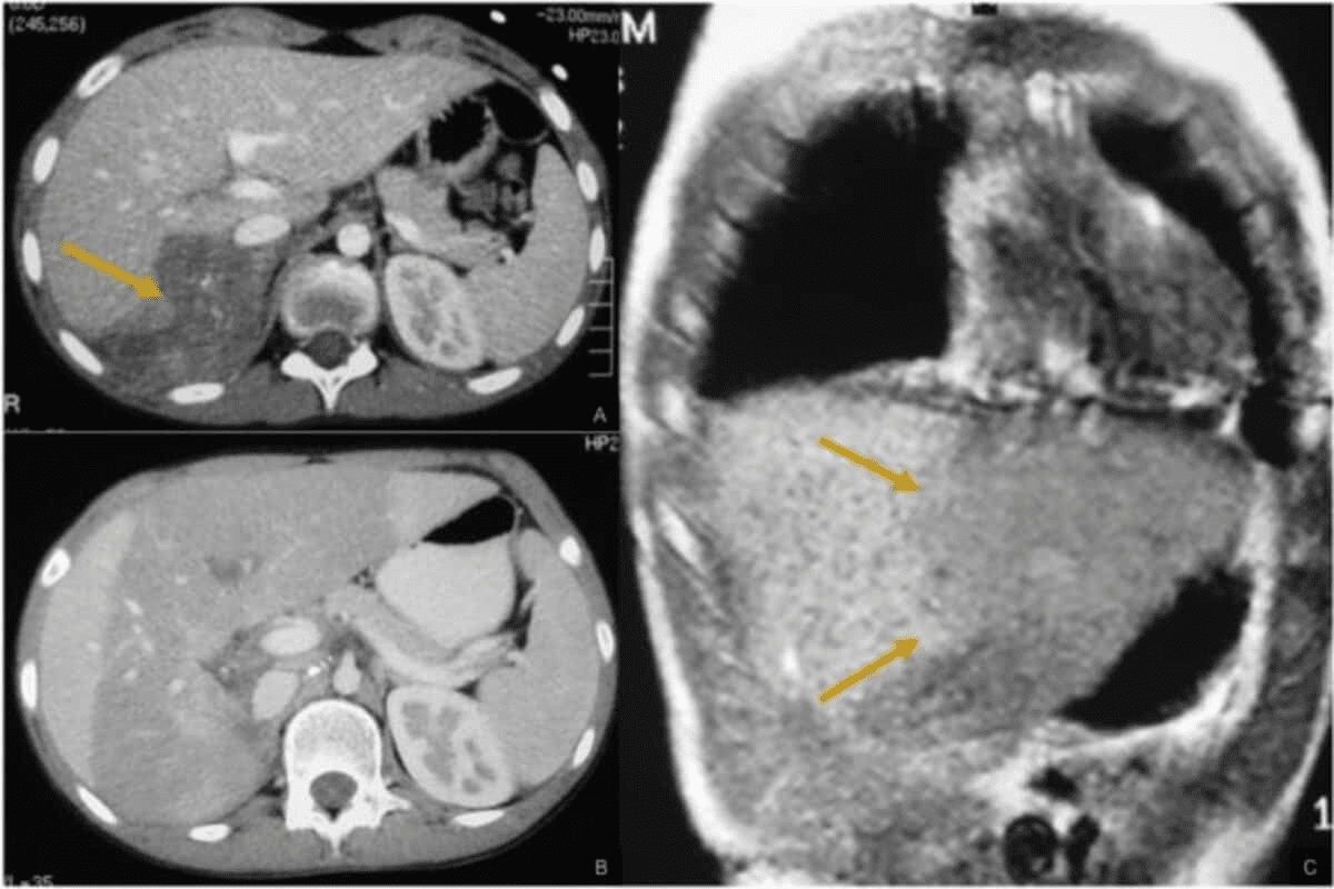 Neuroblastoma Prognosis: Understanding the Last Stage