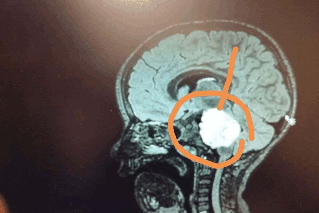 How to Find Out Child Brain Tumor