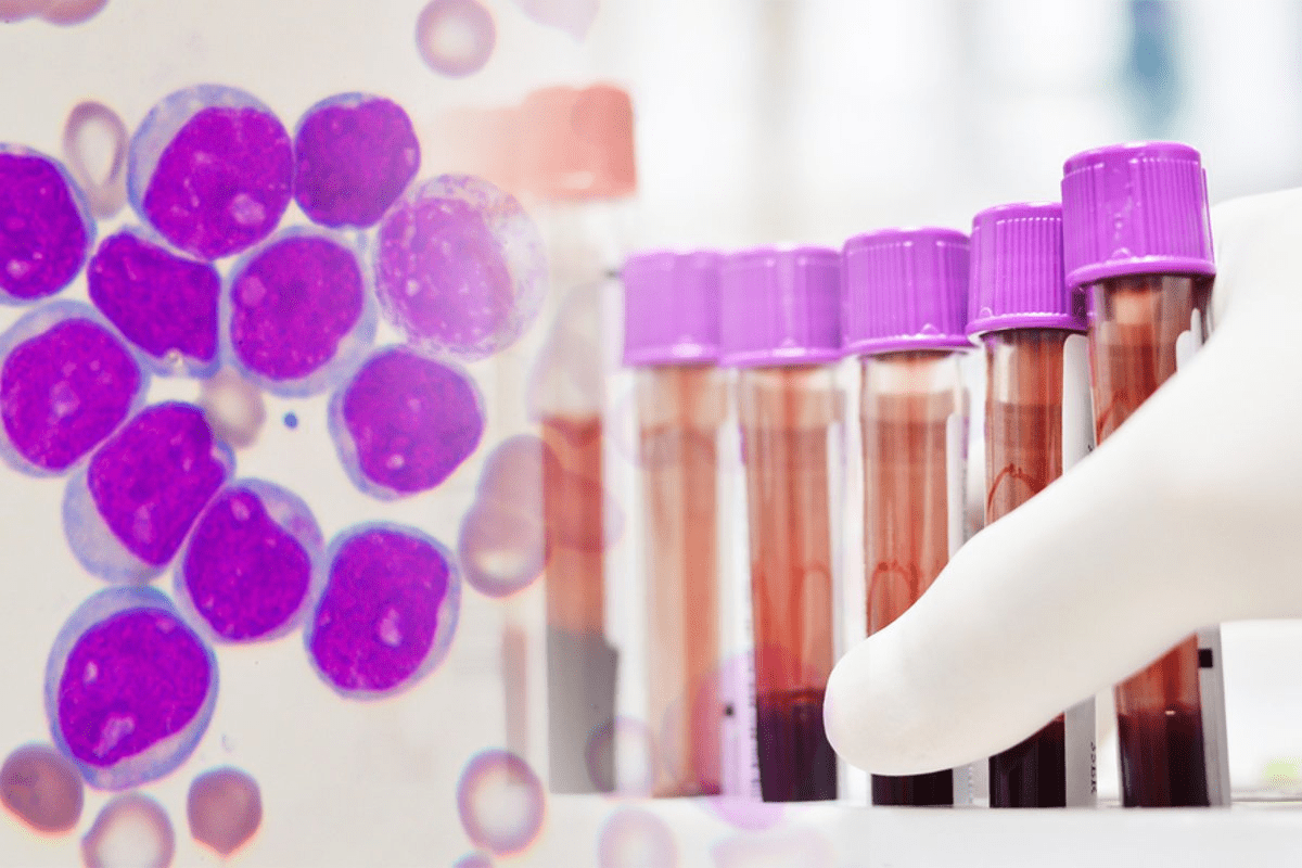 Key Indicators on the CBC lymphoma results Report