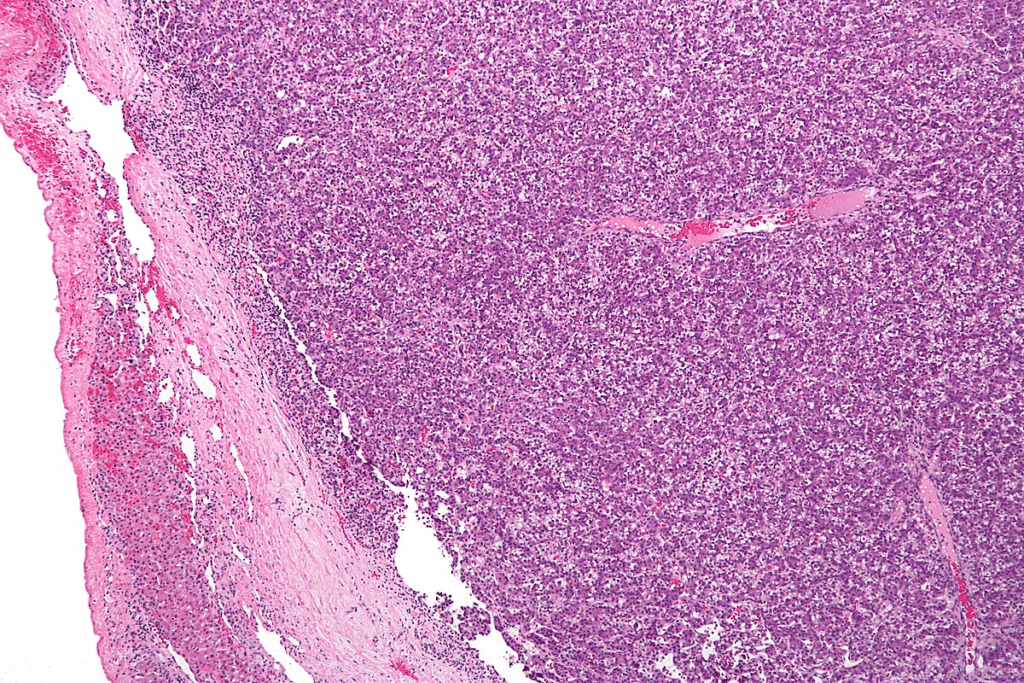 Neuroblastoma Symptoms in Children