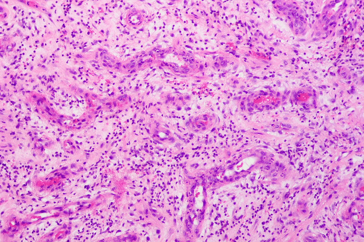 DIPG Cancer in Children