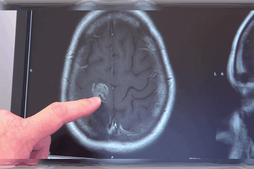 Child Brain Tumor Undiagnosed Signs 2 Child Brain Tumor Undiagnosed Signs