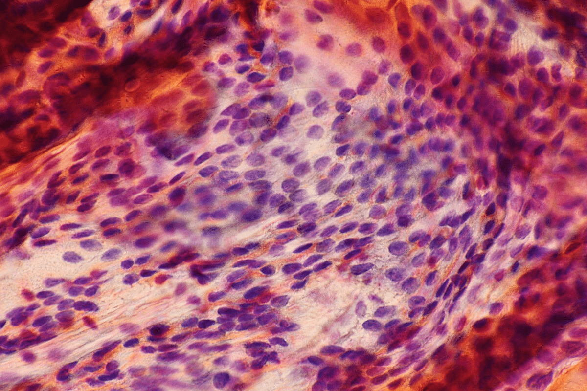 Solid Mass Non-Cancerous