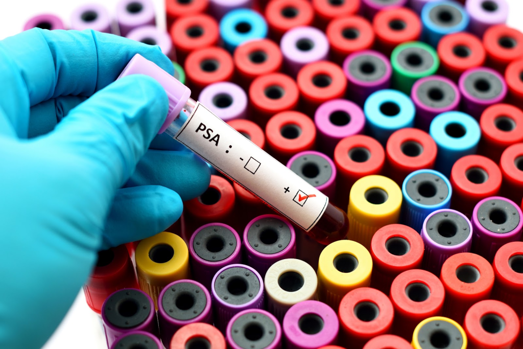 PSA Meaning: Crucial Age to Start PSA Checks