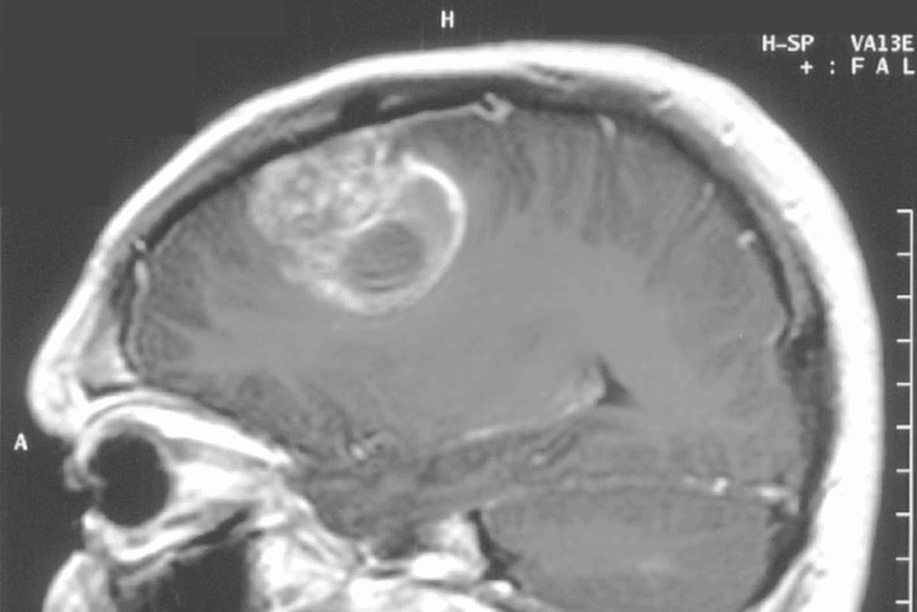 Types of Brain Cancer