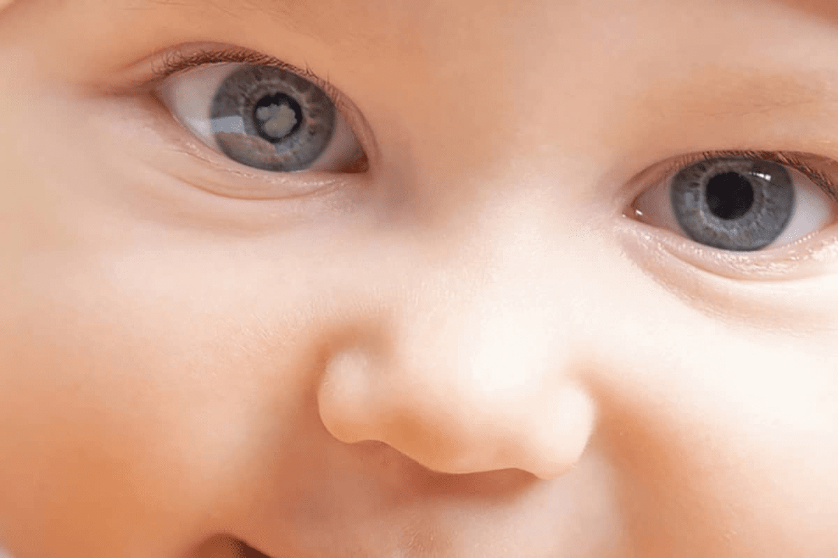Congenital Risk: retinoblastoma causes and Birth Presence