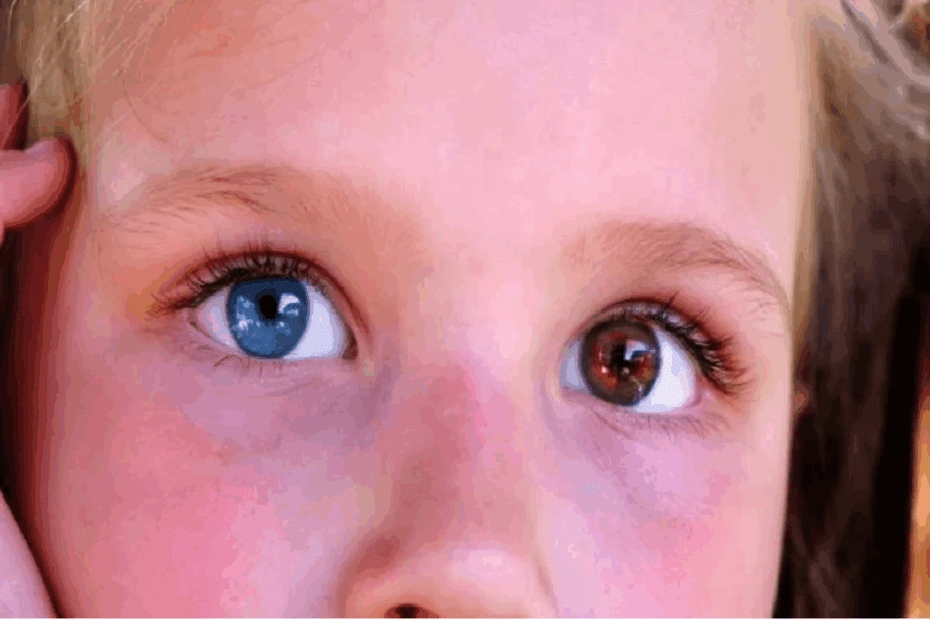 Why Does Retinoblastoma Occur in Children: Great Hope