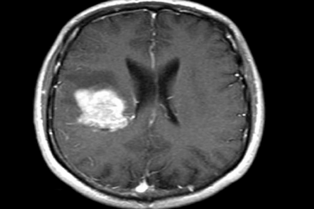 Stages of Solid Tumors