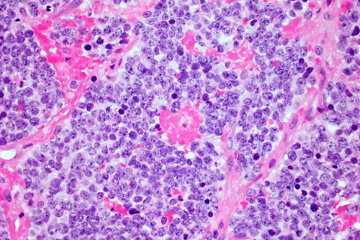 Gender Neuroblastoma: Which Sex Is More Affected?