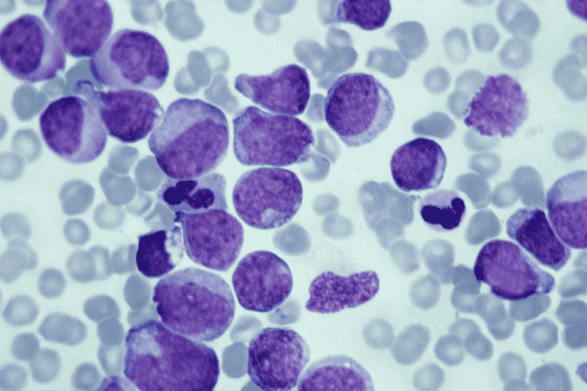 Key Risk factors for childhood leukemia That Parents Should Know