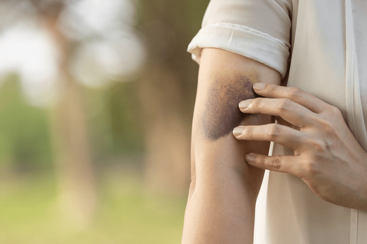 Identifying Leukemia bruises appearance: Location and Characteristics
