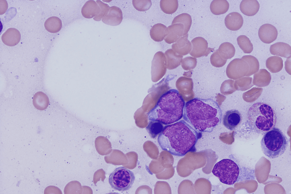 Identifying the Sister disease to leukemia: Myelodysplastic Syndrome