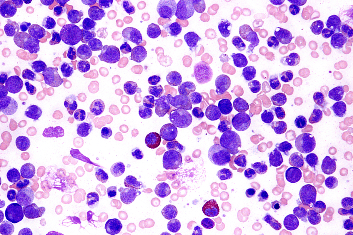 Research on the Causes of leukemia in children: Genes and Environment