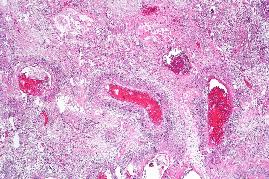 Wilms Tumor Solid Tumor