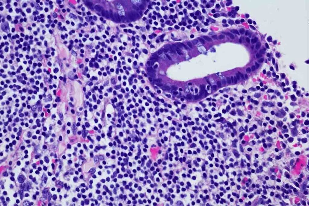 5 Critical Things to Know About Acute Leukemia for Faster Care 3 5 Critical Things to Know About Acute Leukemia for Faster Care