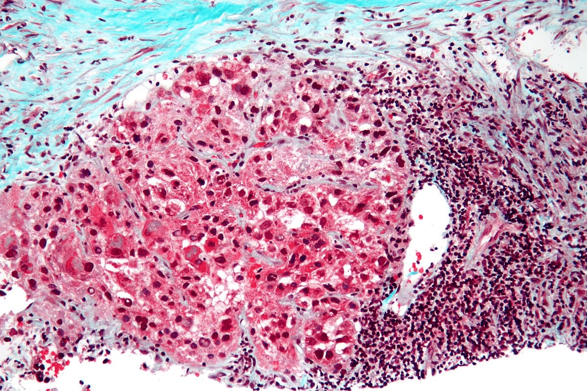 Rhabdomyosarcoma Synonym: Another Name for RMS
