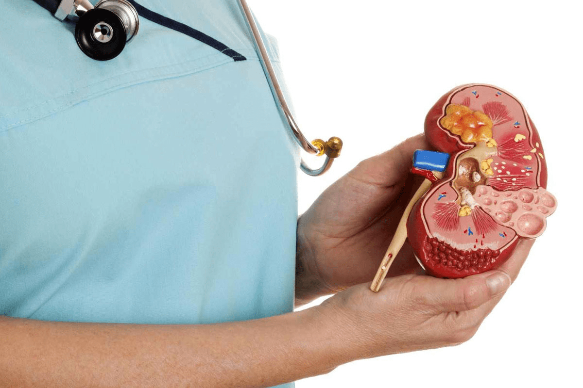 Can Women Get Kidney Stones? Pregnancy Guide