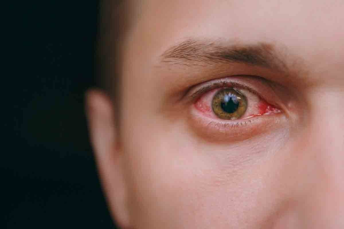 How to Do the Eye Anemia Test and Does Low Iron Cause Blu