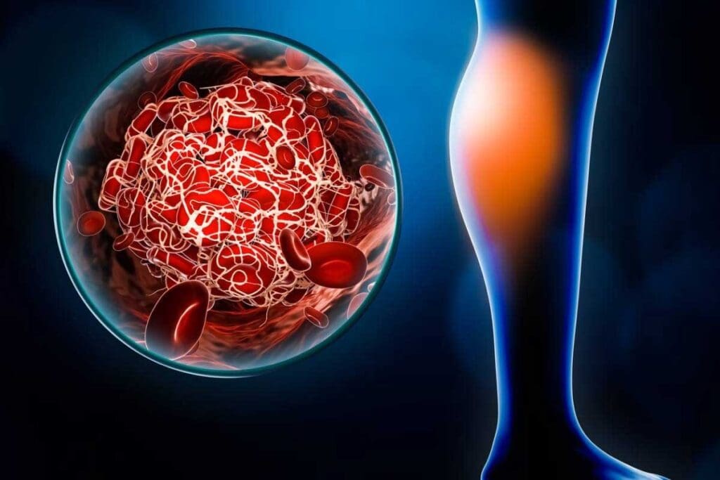 Thrombus Medical Term: 12 Names and Synonyms for Blood Clots Explained