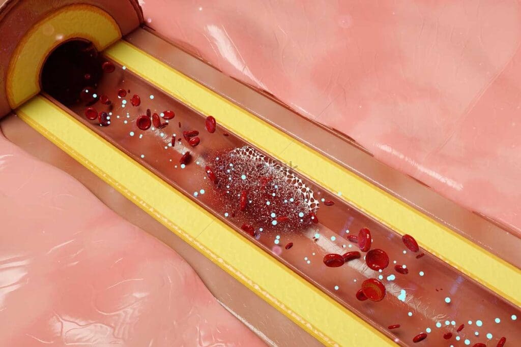 10 Key Facts About Thrombotic Diseases: Symptoms, Types, and Risks 1 10 Key Facts About Thrombotic Diseases: Symptoms, Types, and Risks