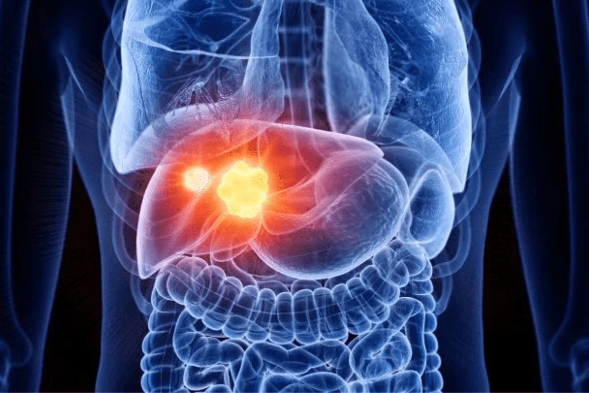 How Big Are Hepatoblastoma Tumors? Cancerous Liver Tumor