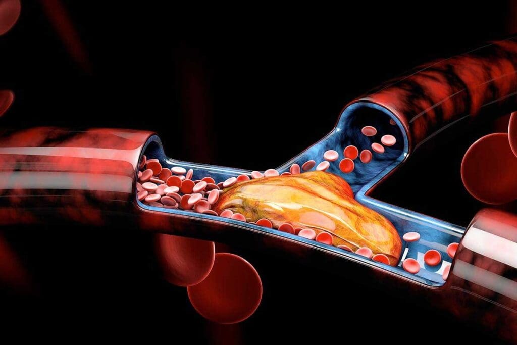 What Is Thrombotic? Understanding Blood Clots That Obstruct Vessels
