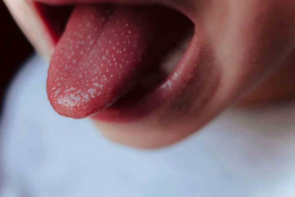 Anemia Tongue Symptoms: 7 Key Signs and Practical Remedies 2 Anemia Tongue Symptoms: 7 Key Signs and Practical Remedies