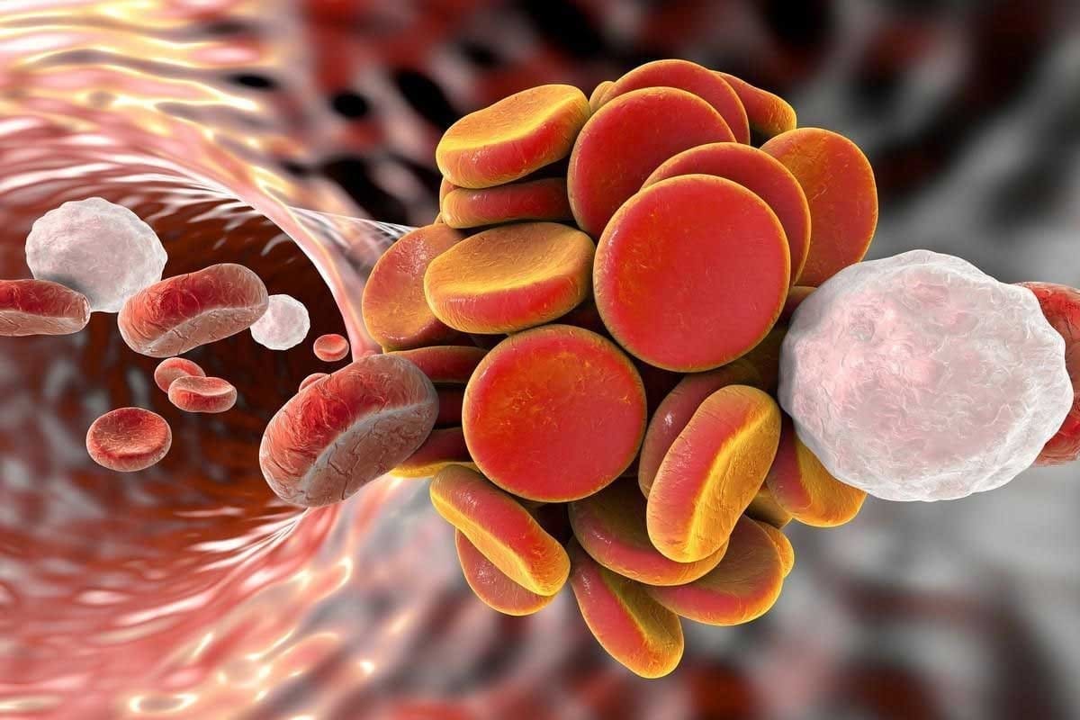 12 Essential Medical Terminology for Blood Clot and Blood Clotting Explained