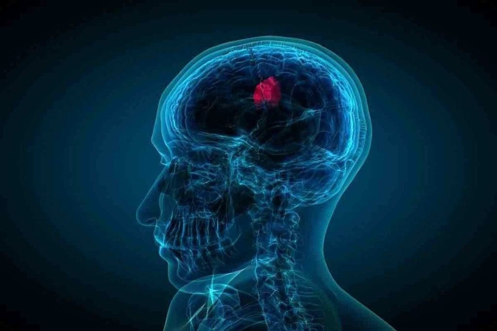 Can Brain Tumor Be Cured by Medicines?