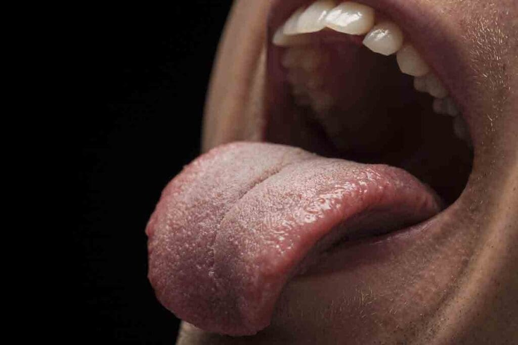 9 Key Signs of Pernicious Anemia Tongue: Pictures, Glossitis, and More