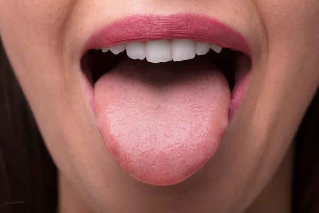 Iron Deficiency on Tongue: 7 Key Symptoms and Signs to Watch For 1 Iron Deficiency on Tongue: 7 Key Symptoms and Signs to Watch For