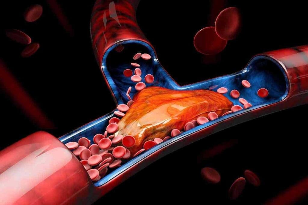What Causes Thrombosis and What Are the Main Risk Factors for Blood Clots?