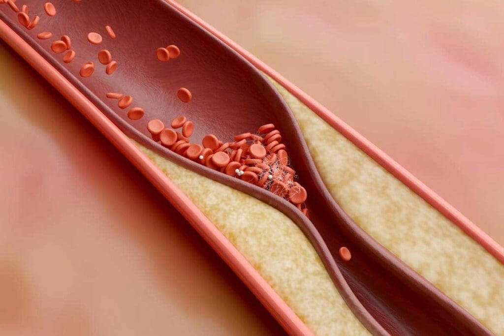 What Causes Thrombosis and What Are the Main Risk Factors for Blood Clots?