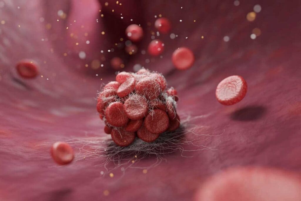 7 Different Types of Blood Clots: Names, Descriptions, and How They Form