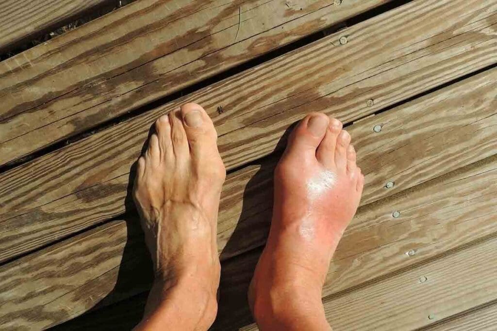 What Does a Blood Clot on Top of the Foot Look and Feel Like? (blood clot on top of foot pictures) 3 What Does a Blood Clot on Top of the Foot Look and Feel Like? (blood clot on top of foot pictures)