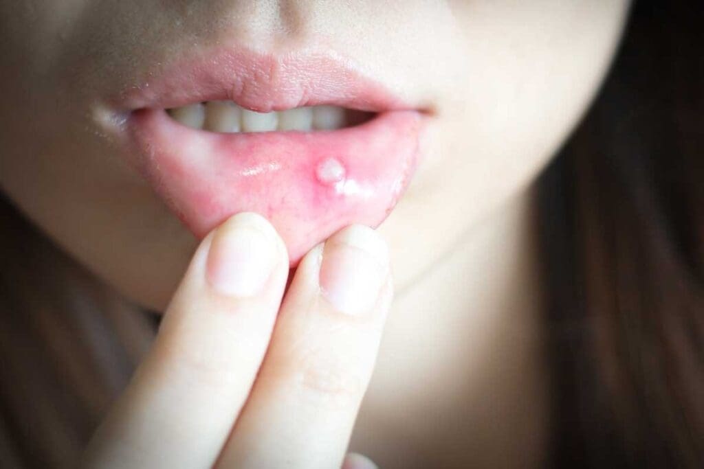 Anemia Mouth Sores: Can Low Iron Cause Ulcers? What to Know About Oral Health
