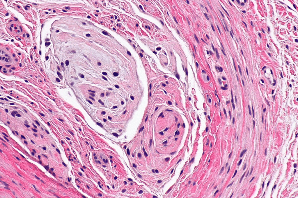 AVM: Understanding the Shocking Facts About GI Arteriovenous Malformation