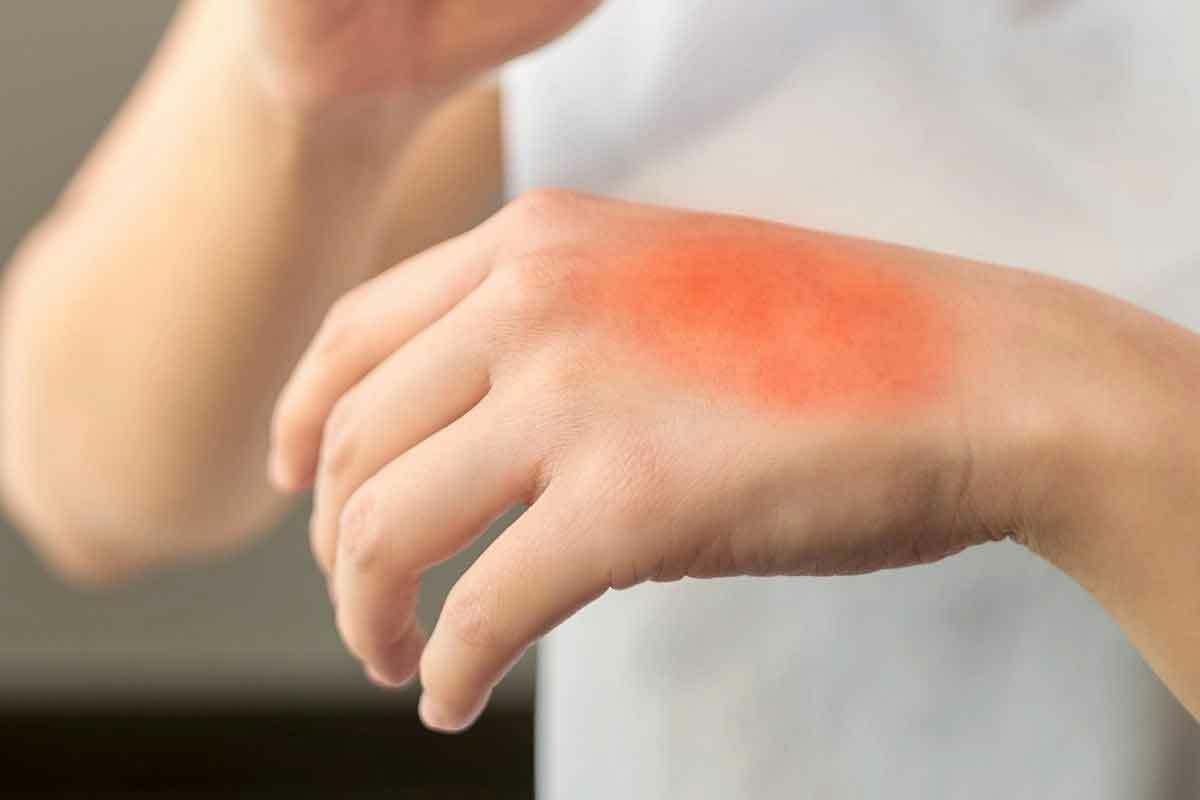Treatments For Radiation Burns: 7 Essential & Effective Cures