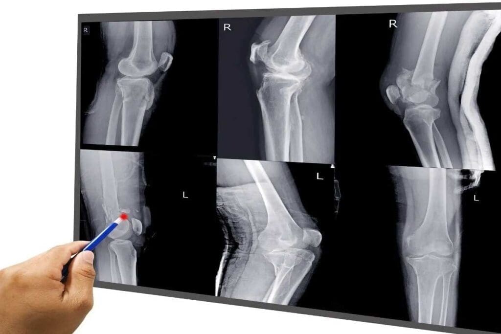 Does MRI Show Broken Bones Compared to X-Ray & CT?