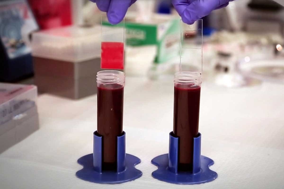 Blood Clot from Airplane: 5 Essential Tips to Travel Safely