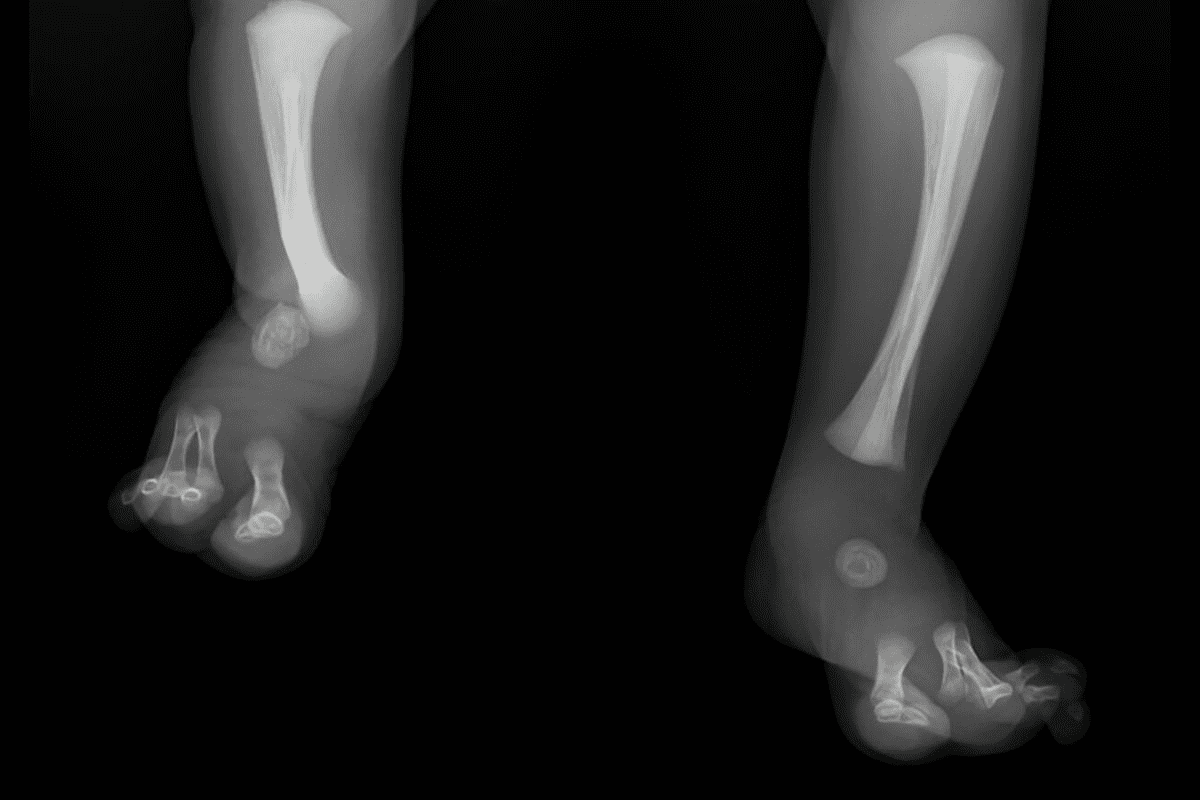 Cobb Syndrome AVM: Important Facts to Know