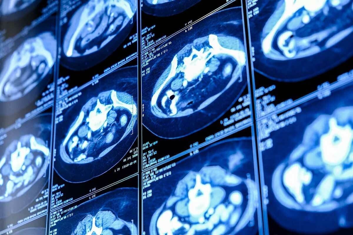 Nuclear Kidney Scan: Procedure & Tips