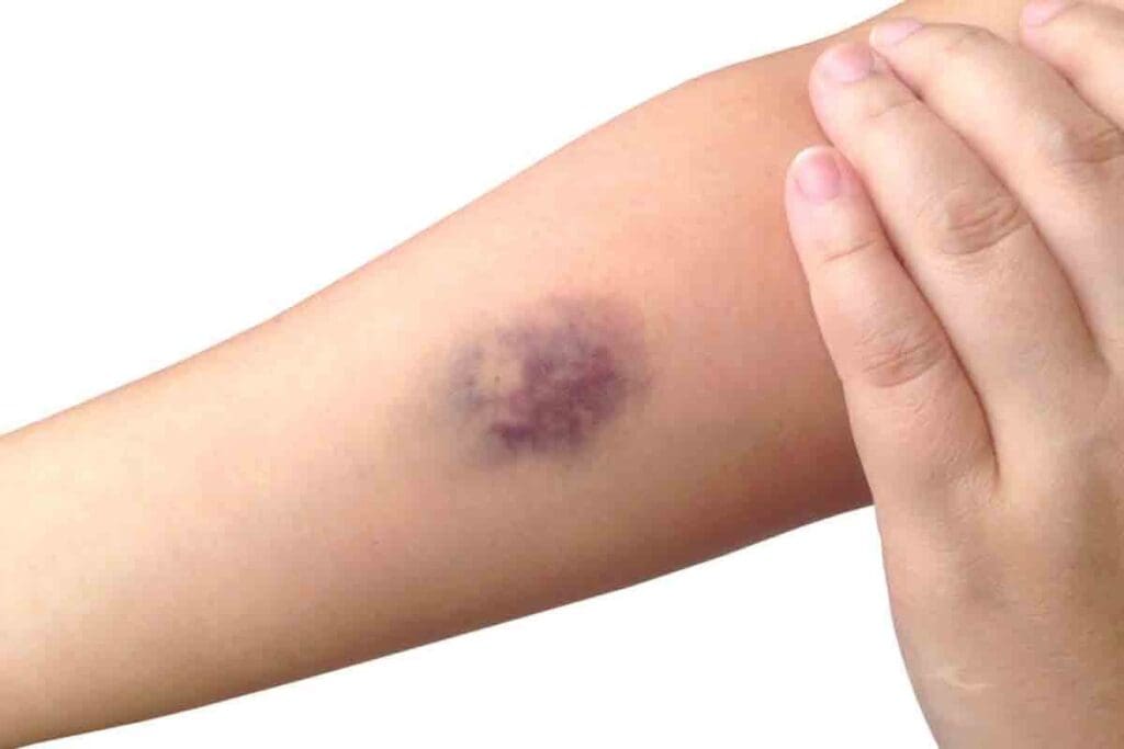 7 Key Blood Clot in Arm Symptoms and Warning Signs You Shouldn't Ignore 3 7 Key Blood Clot in Arm Symptoms and Warning Signs You Shouldn't Ignore