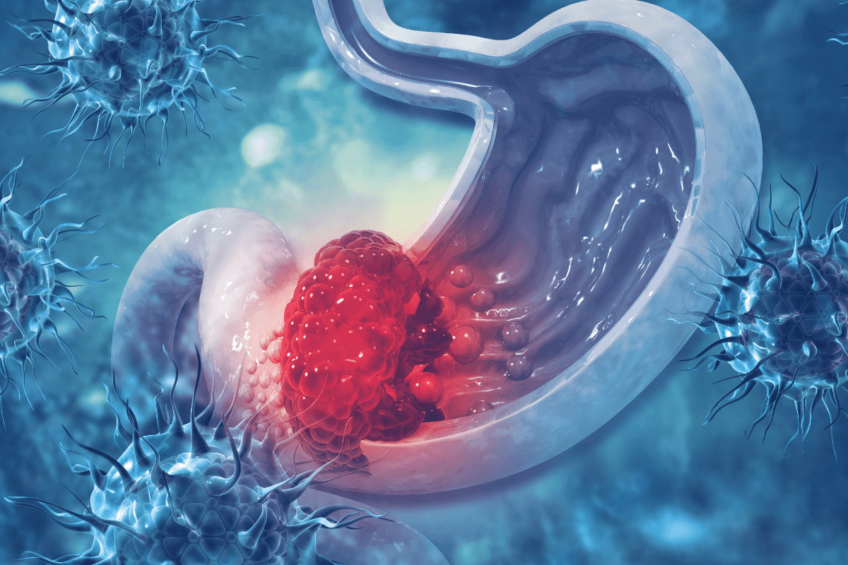 Fabry Disease Symptoms: GI Problems You Must Know