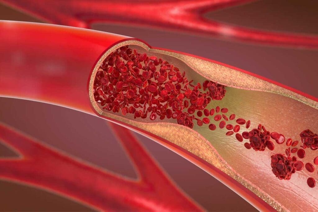 What Does DVT Pain Feel Like and How Is It Different From a Pulled Muscle?