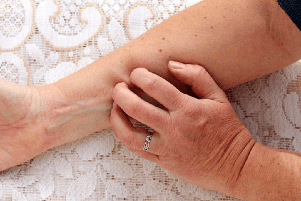 Thrombocytopenia Bruising: Unlucky Side Effect