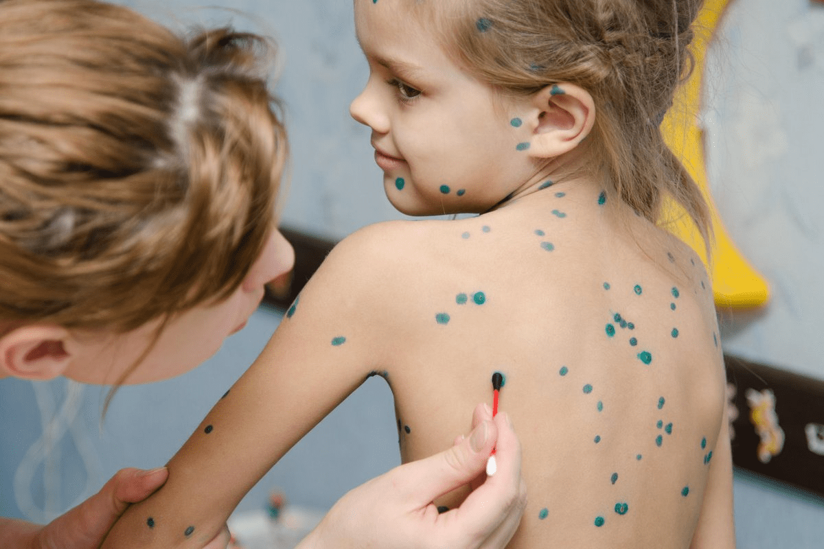 Chickenpox Thrombocytopenia: Negative Link Explained