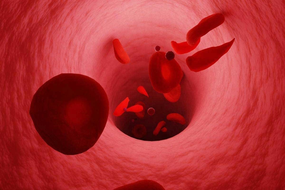 What Are Irregular Red Blood Cells (Acanthocytes)? Meaning, Types, and Key Causes Explained