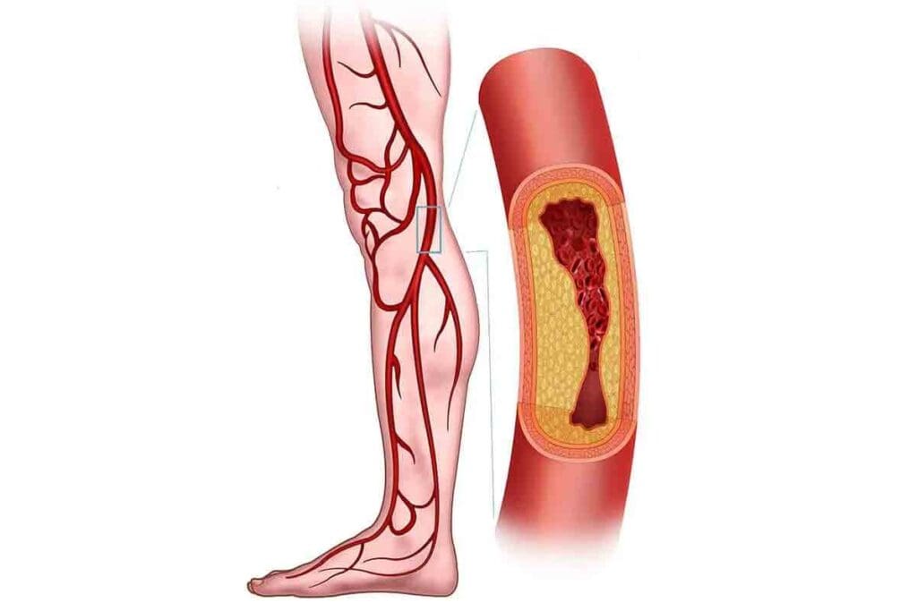 Blood Clot in Leg Symptoms: 7 Key Warning Signs to Watch For